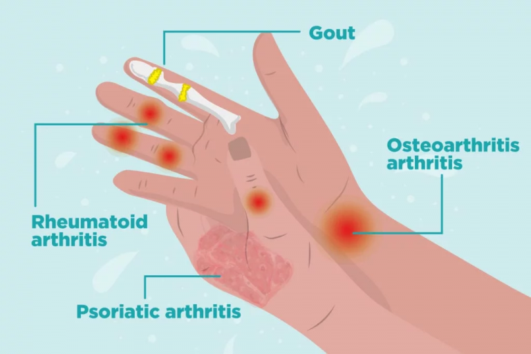 What Coping With Rheumatoid Arthritis Symptoms Signs and symptoms Signs and signs and symptoms