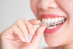 Revolutionising Smile Aesthetics How Invisalign Transforms Dental Alignment